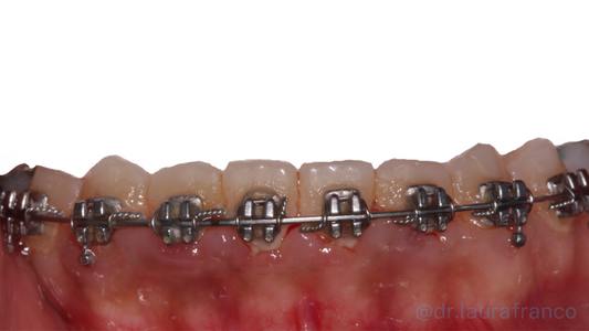 Ortodoncia y Encías Inflamadas: ¿Cómo se relacionan?